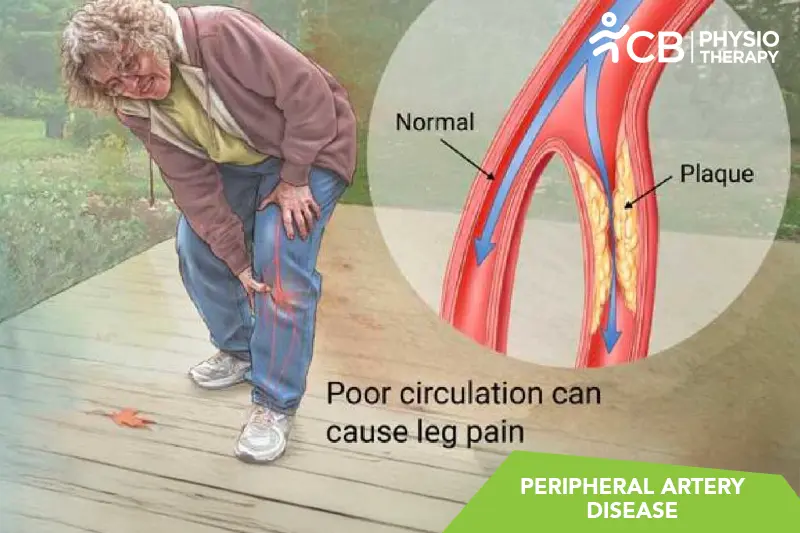 Peripheral Artery Disease (pad)