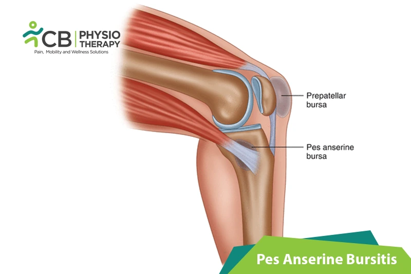 Pes Anserine Bursitis