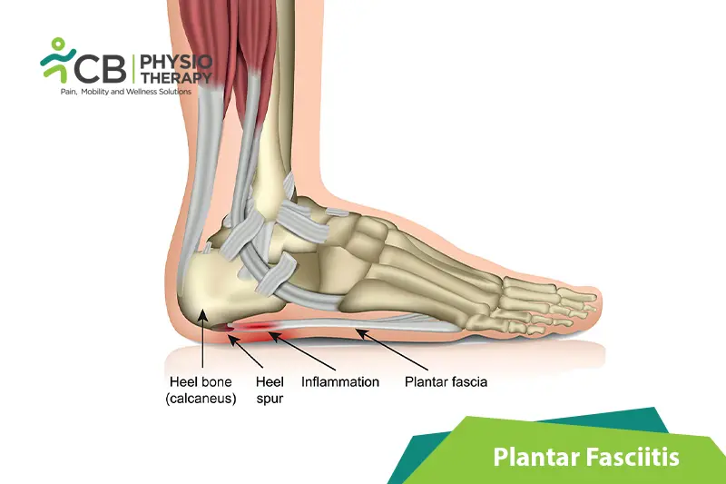 Plantar Fasciitis