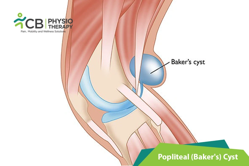Popliteal (baker's) Cyst