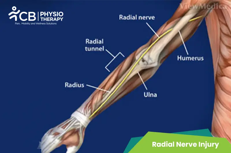 Radial Nerve Injury