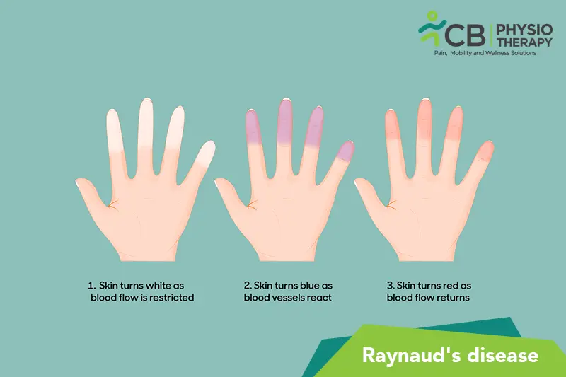 Raynaud’s Disease