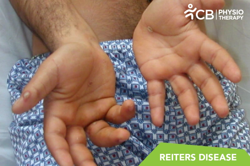Reiter's Syndrome