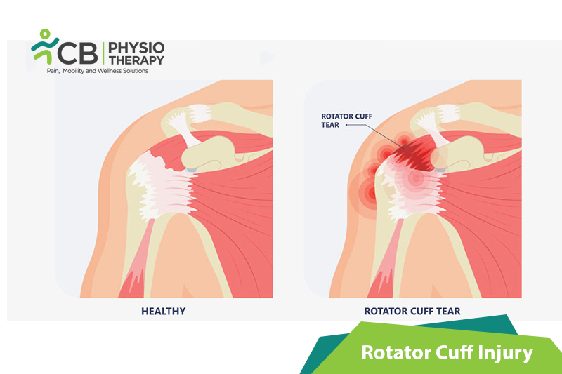 Rotator Cuff Injury