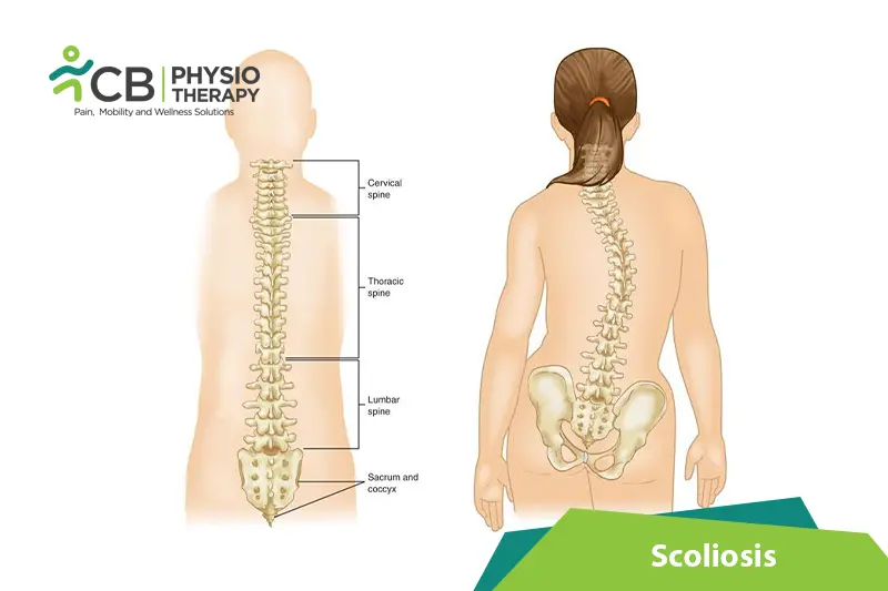 Scoliosis