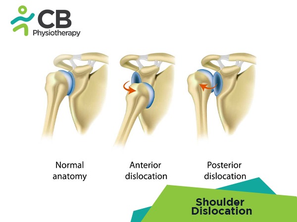 Shoulder Dislocation