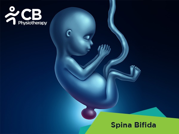 Spina Bifida