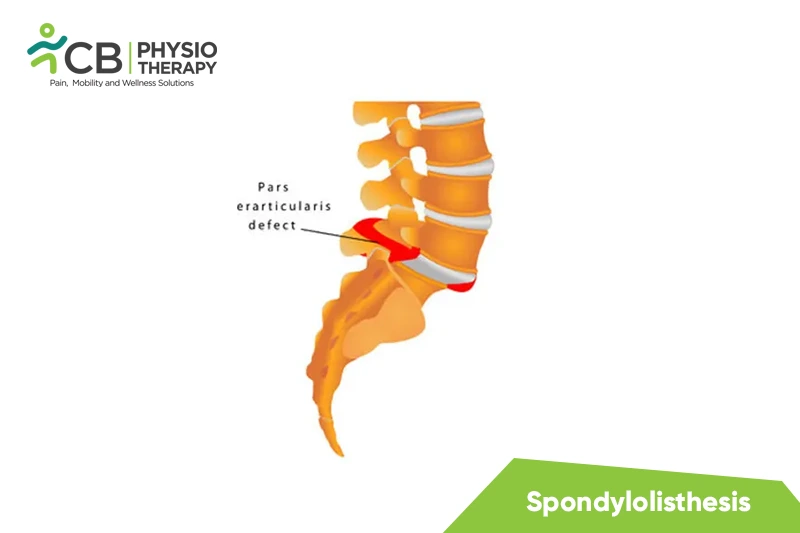 Spondylolisthesis