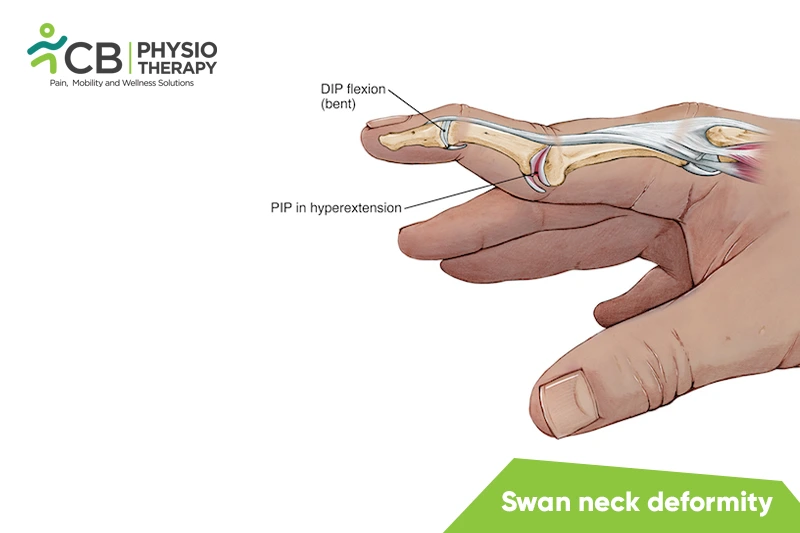 Swan Neck Deformity