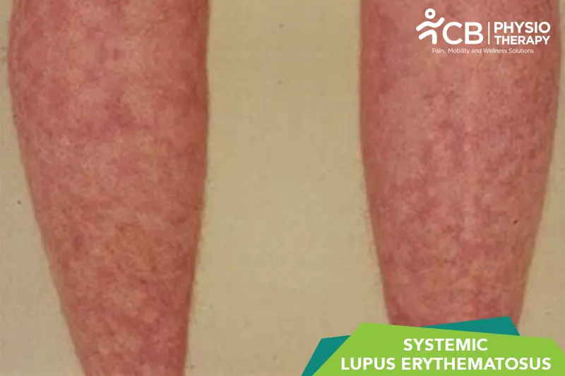 Systemic Lupus Erythematosus (sle)