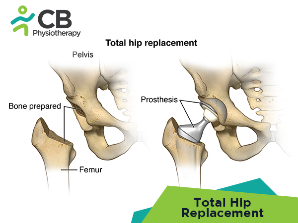 Total Hip Replacement (thr)