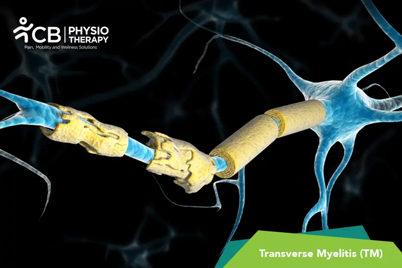 Transverse Myelitis (tm)