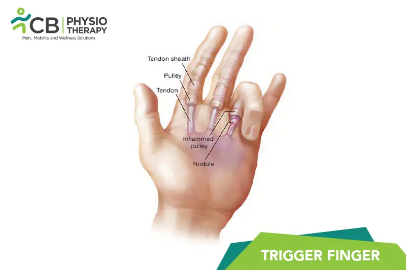 Trigger Finger