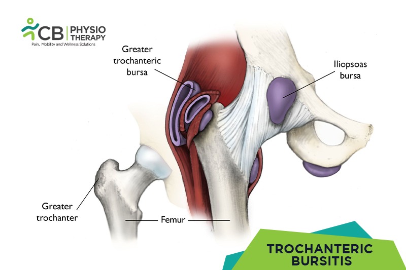 Trochanteric Bursitis