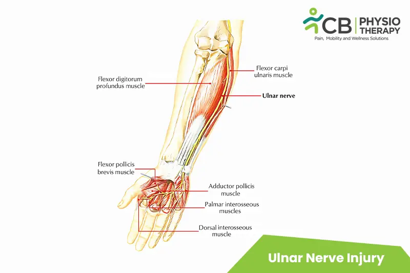 Ulnar Nerve Injury