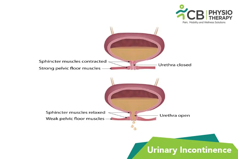 Urinary Incontinence