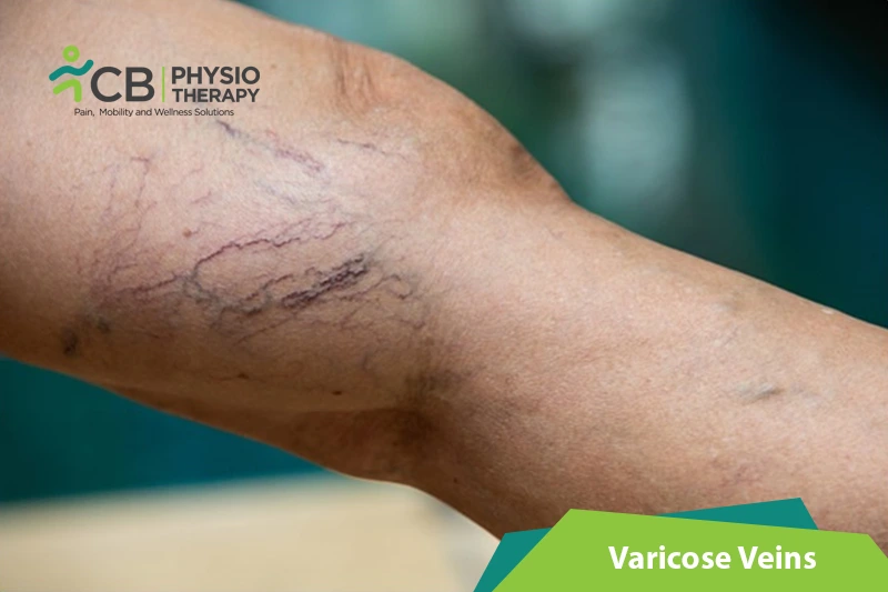 Varicose Veins