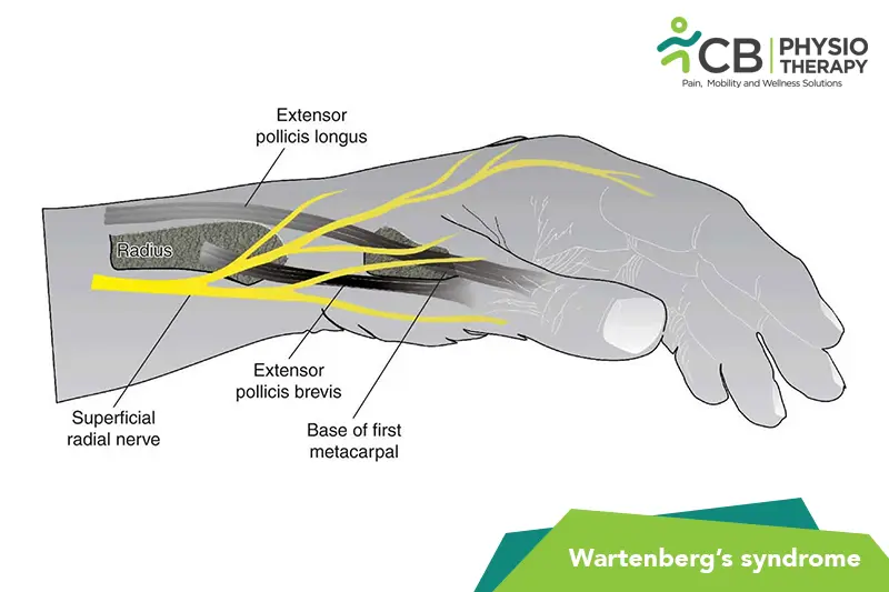 Wartenberg’s Syndrome