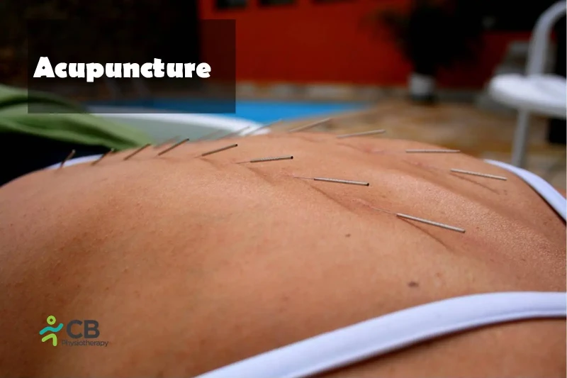 Acupuncture