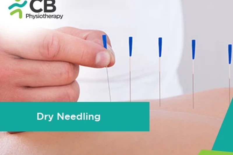 Dry Needling Therapy