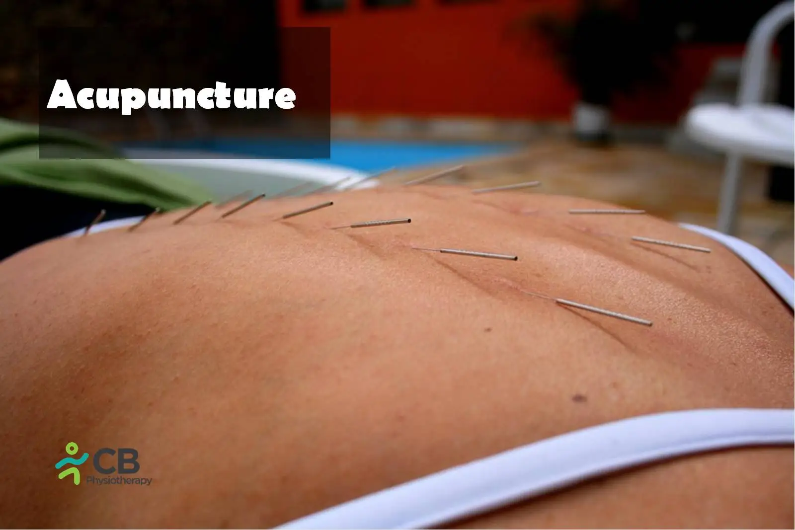 Acupuncture