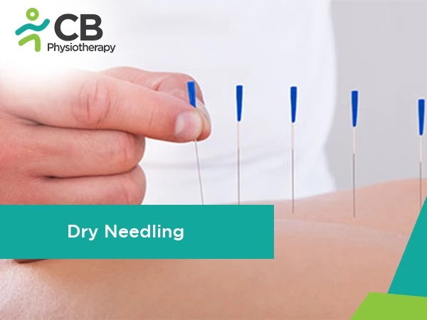 Dry Needling Therapy